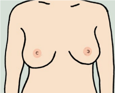 Breast Screening
