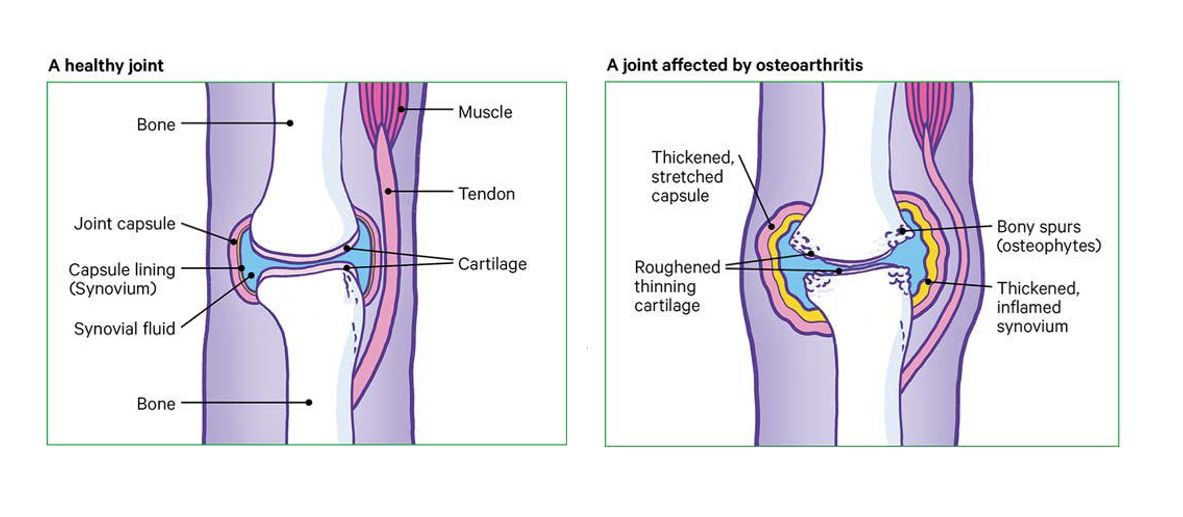 Osteoarthritis