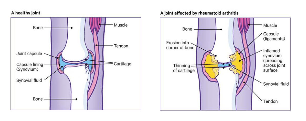 rheumatoid arthritis